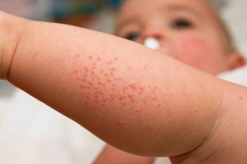 Alergia la un copil ca simptom al prezenței viermilor