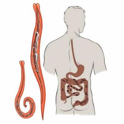 viermi în intestinele umane